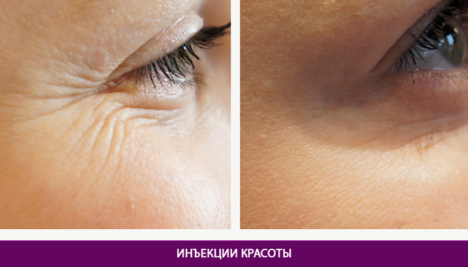 Ін’єкційні процедури - фото до и после № 1