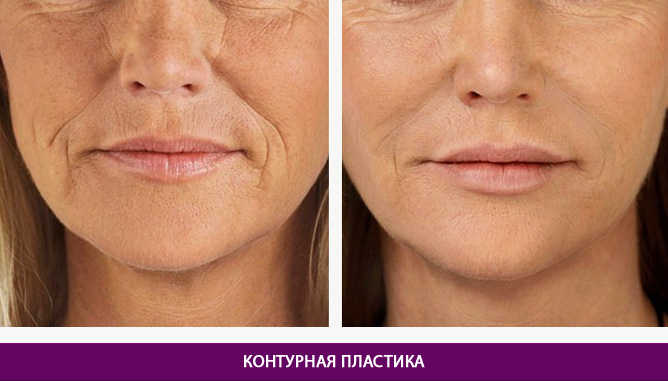 Ін’єкційні процедури - фото до и после № 2