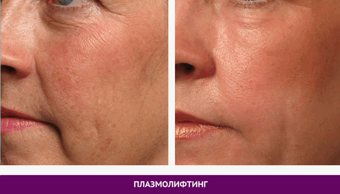 Ін’єкційні процедури - фото до и после № 3