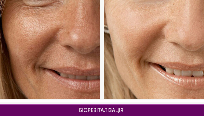 Біоревіталізація - фото до и после № 1