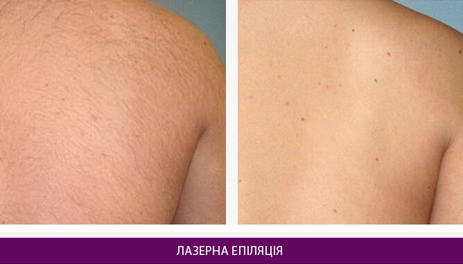 Лазерна епіляція - фото до и после № 3