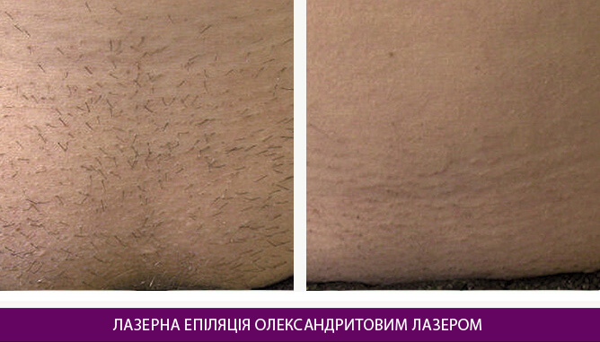 Лазерна епіляція олександритовим лазером - фото до и после № 3