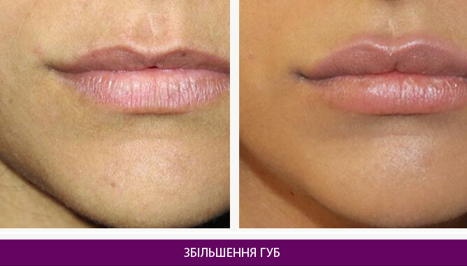 Збільшення губ - фото до и после № 1