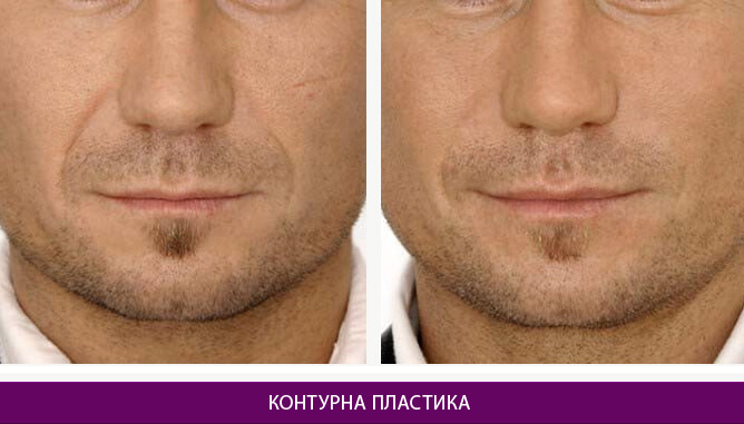 Контурна пластика - фото до и после № 2