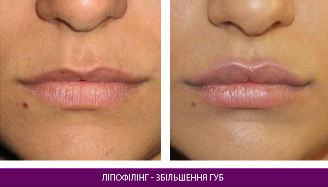 Ліпофілінг - фото до и после № 1