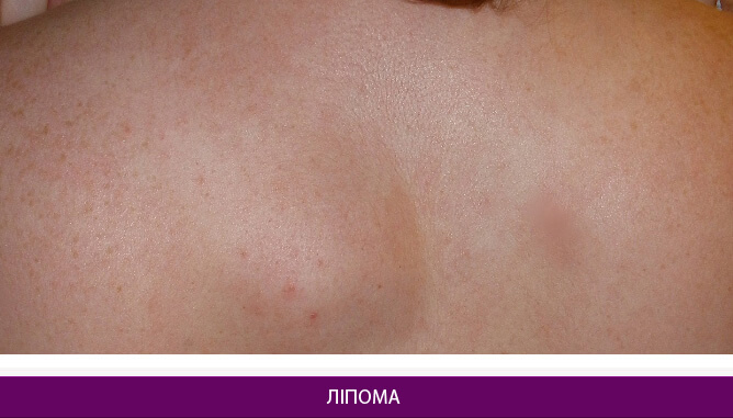 Видалення ліпоми - фото до и после № 1