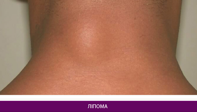 Видалення ліпоми - фото до и после № 2