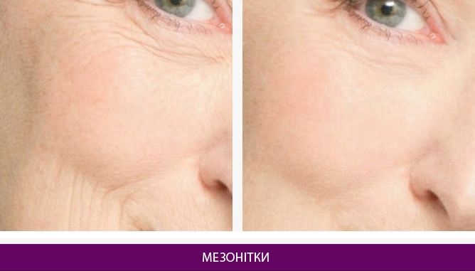 Мезонитки - фото до и после № 1