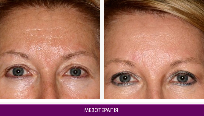 Мезотерапія - фото до и после № 1