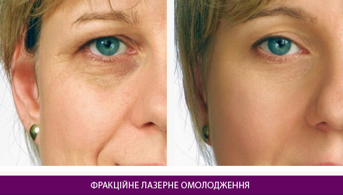 Фракційне лазерне омолодження - фото до и после № 2