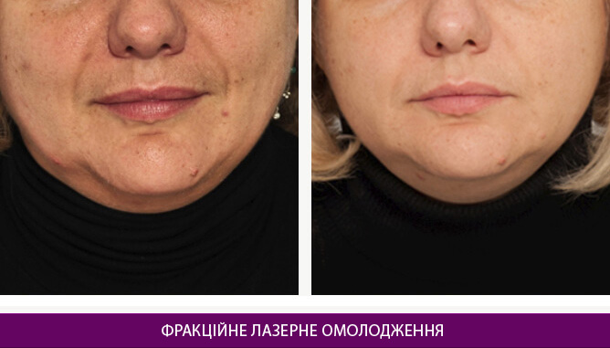 Фракційне лазерне омолодження - фото до и после № 3