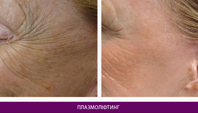 Плазмоліфтинг - фото до и после № 1