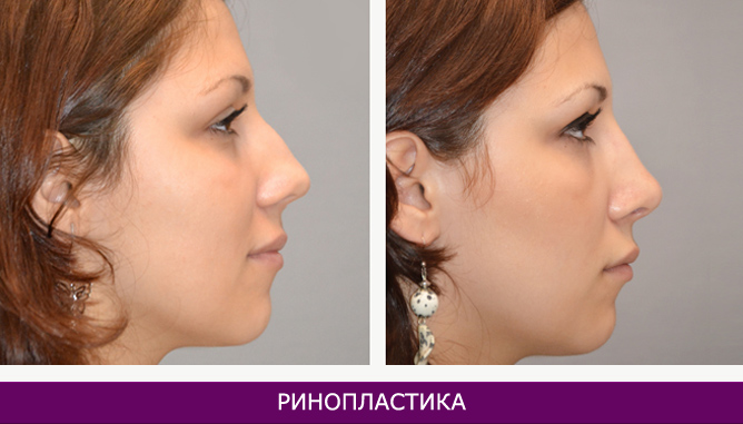 Ринопластика (пластика носа) - фото до и после № 1