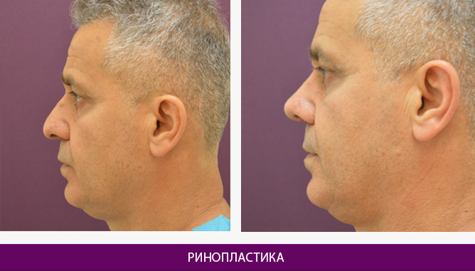 Ринопластика (пластика носа) - фото до и после № 2