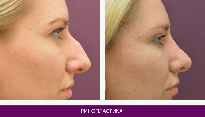 Ринопластика (пластика носа) - фото до и после № 6