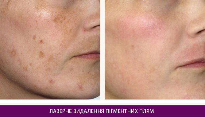 Лазерне видалення пігментних плям - фото до и после № 1