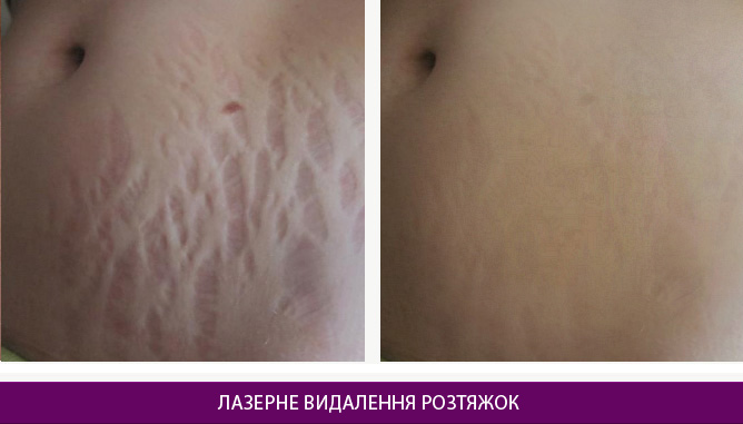 Лазерне видалення розтяжок - фото до и после № 1