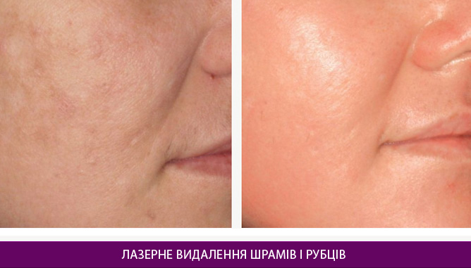 Лазерне видалення шрамів і рубців - фото до и после № 1