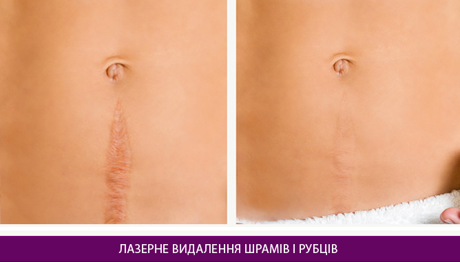 Лазерне видалення шрамів і рубців - фото до и после № 3
