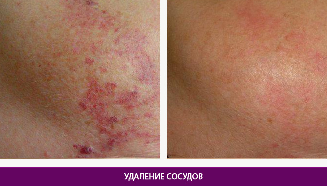 Лазерное удаление сосудов - фото до и после № 2