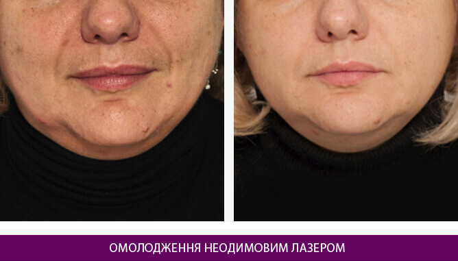 Омолодження неодимовим лазером - фото до и после № 2