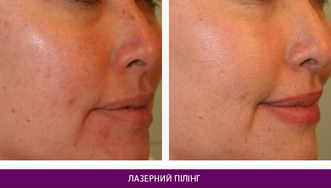 Лазерний пілінг - фото до и после № 1