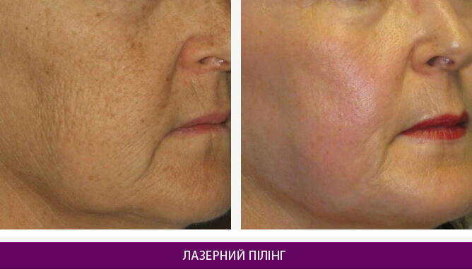 Лазерний пілінг - фото до и после № 2