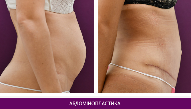 Абдомінопластика - фото до и после № 2