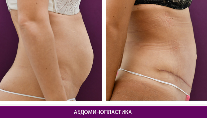 Абдоминопластика - фото до и после № 2