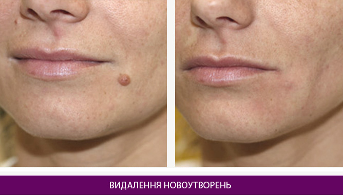 Лазерне видалення новоутворень - фото до и после № 1