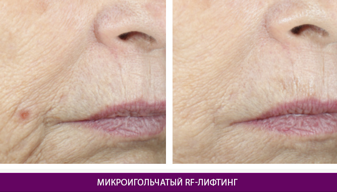 Микроигольчатый RF-лифтинг - фото до и после № 1
