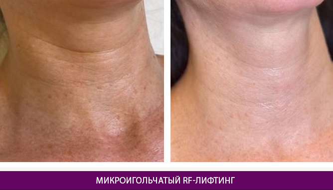Микроигольчатый RF-лифтинг - фото до и после № 4