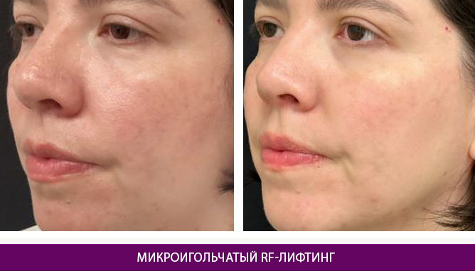 Микроигольчатый RF-лифтинг - фото до и после № 2